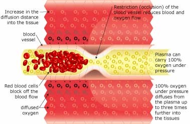 Hyperbaric Oxygenation