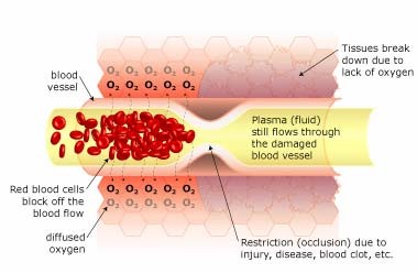 Restricted Blood Flow